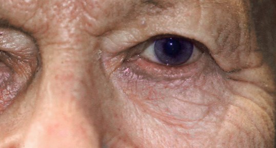 eyelid repair surgery on female patients eyes