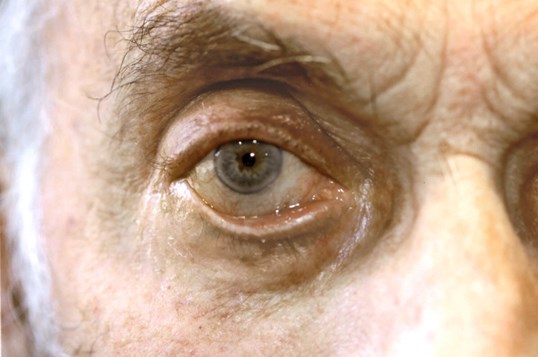close up of male sagging eyelid before eyelid repair surgery