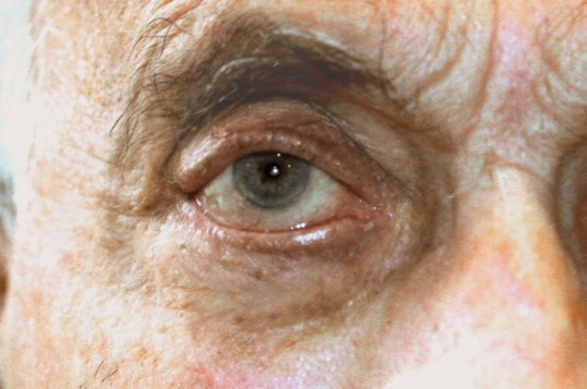 close up of male patients eye getting eyelid repair surgery at sightmd