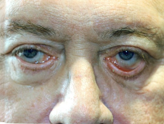 closeup of male patients eyelids sagging before eyelid repair surgery