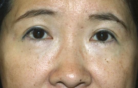close up of female eyes after blepharoplasty procedure