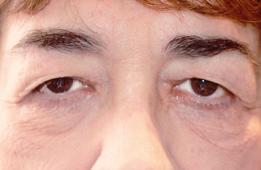 asian male patient after blepharoplasty