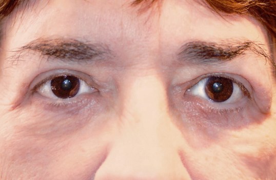 female eyes after blepharoplasty surgery