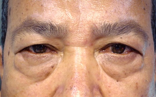 male asian patient after blepharoplasty surgery