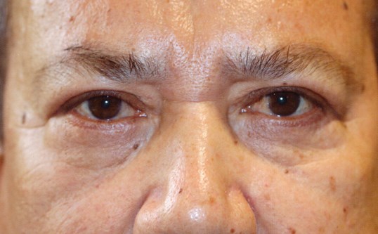 male patient after blepharoplasty by james gordon