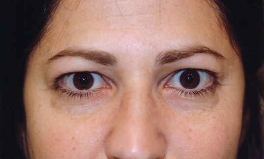 female brown eyes after blepharoplasty