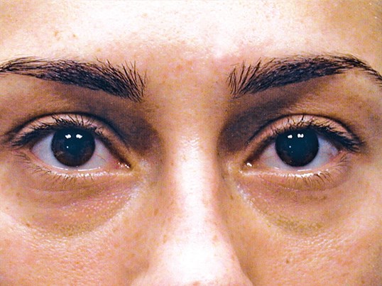 female patient after blepharoplasty with fresh looking eyes
