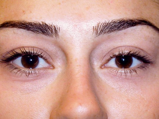 young woman before blepharoplasty