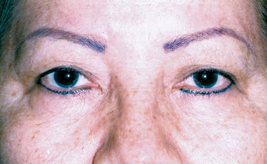 female patient dark blue eyes blepharoplasty results