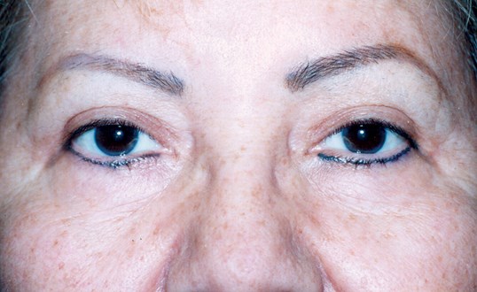 middle aged woman results after blepharoplasty