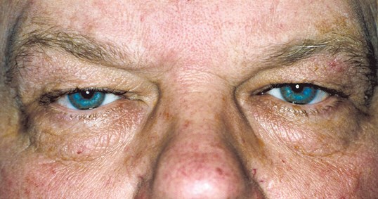 male patient with bright blue eyes after blepharoplasty surgery