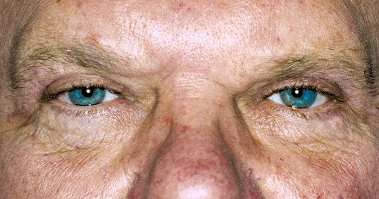 blepharoplasty results on older male