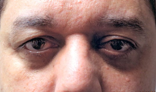 male patient with brown eyes after blepharoplasty