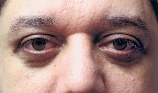 blepharoplasty results on middle aged male patient