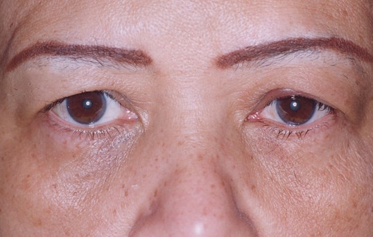 female patient with refreshed looking eyes after blepharoplasty