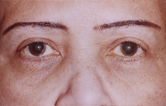 front facing results of blepharoplasty surgery on eye