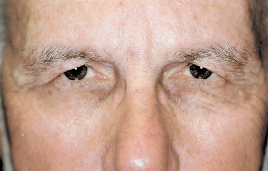 blepharoplasty treatment on older male