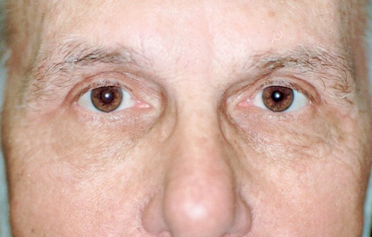 eyes after receiving a blepharoplasty surgical procedure