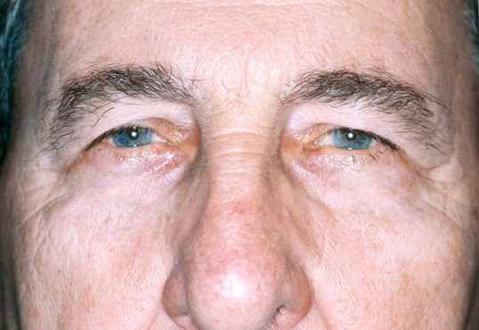 male patient after blepharoplasty surgery with bright blue eyes