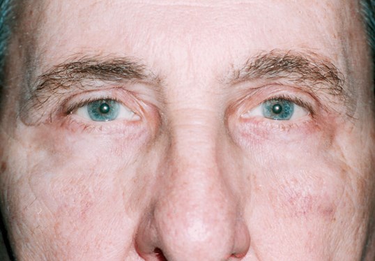 close up of male patients eyes following a blepharoplasty