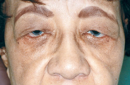 female patient with sagging and tired looking eyes before a blepharoplasty procedure