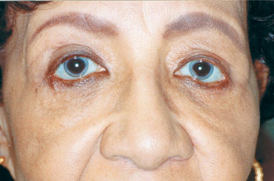 close up of womans eyes immediately after blepharoplasty