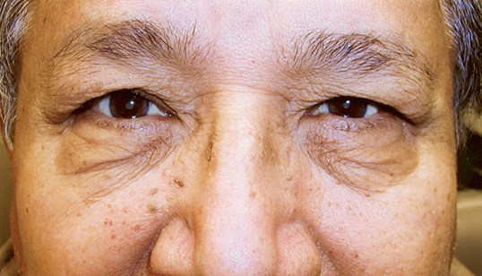 asian male patient with scrunched looking eyes before blepharoplasty