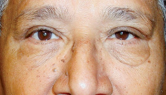 male patient receiving blepharoplasty results