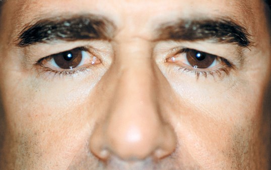 male patient with brown eyes before blepharoplasty with dr. James Gordon