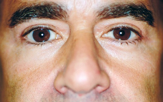 male patient after blepharoplasty results