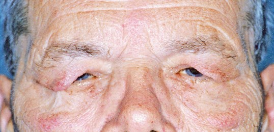 before blepharoplasty surgery male with closed eyes
