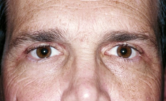male patient after blepharoplasty results of surgery