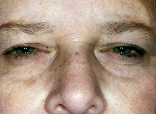 woman with closed looking eyes before a blepharoplasty