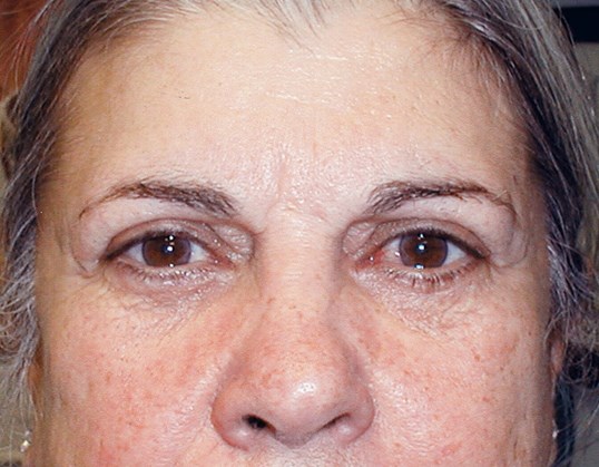 woman front facing after receiving blepharoplasty