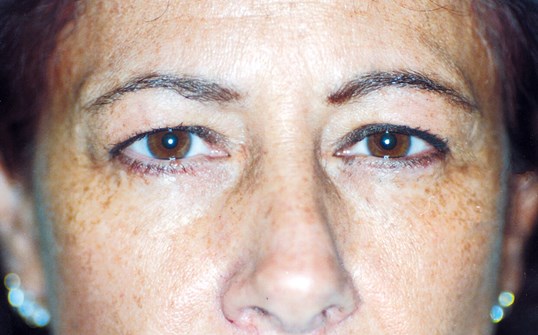 woman before and after blepharoplasty procedure
