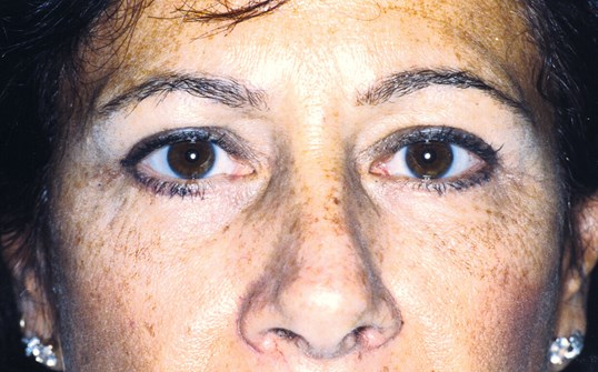 woman looking forward after blepharoplasty surgery