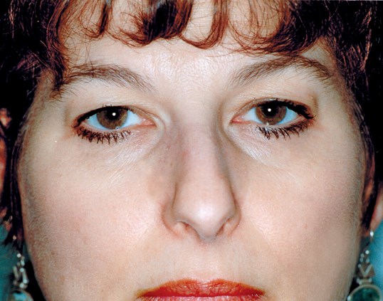 woman brown eyes close up before and after procedure