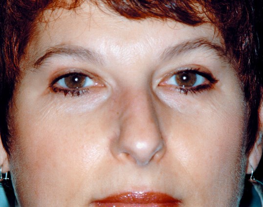 straight forward looking woman after blepharoplasty