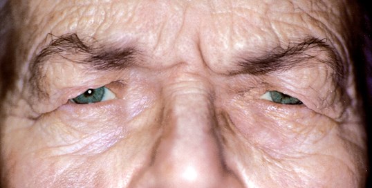 male before blepharoplasty scrunched and "covered" looking eyes