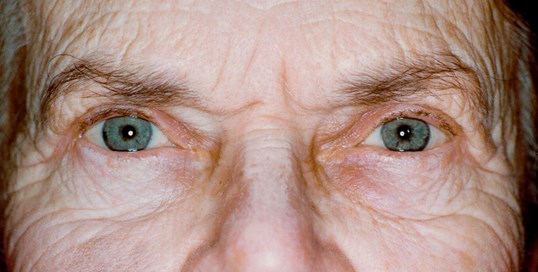 male looking straight ahead with blepharoplasty procedure results