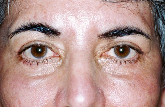 results of blepharoplasty on male