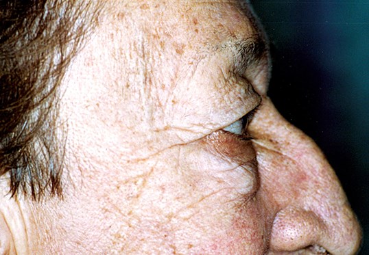 male before blepharoplasty side profile