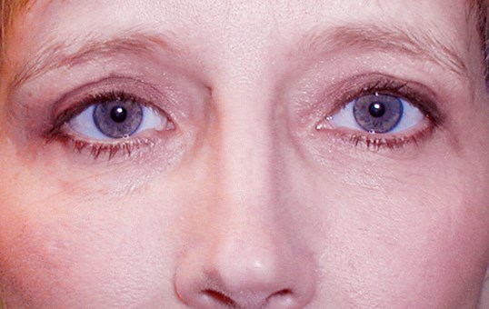 female patient front facing after blepharoplasty procedure