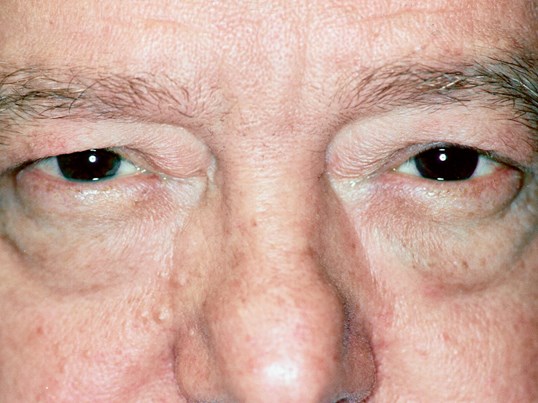 male patient before blepharoplasty surgery