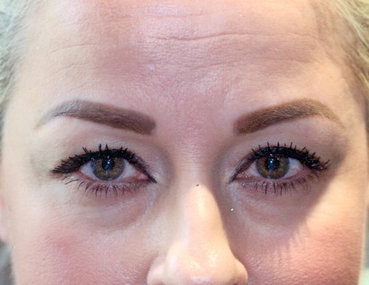 wrinkles lines on the upper face and forehead of a female patient before botox
