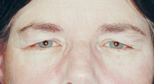 female patient close up of eyes before blepharoplasty