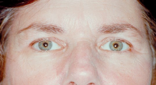 blepharoplasty results on a middle aged man facing forward