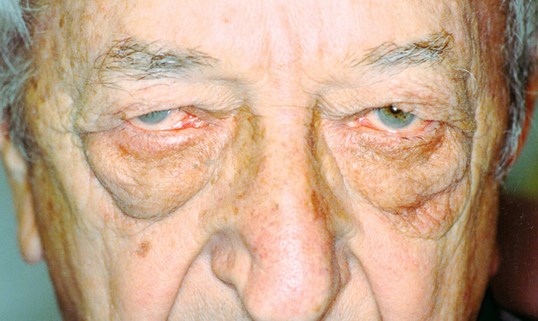 male patient with tired sagging eyes before blepharoplasty surgery