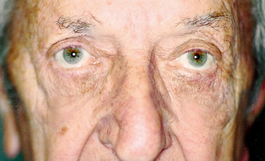 results of blepharoplasty on older male patient