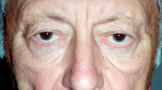 male patient blepharoplasty results